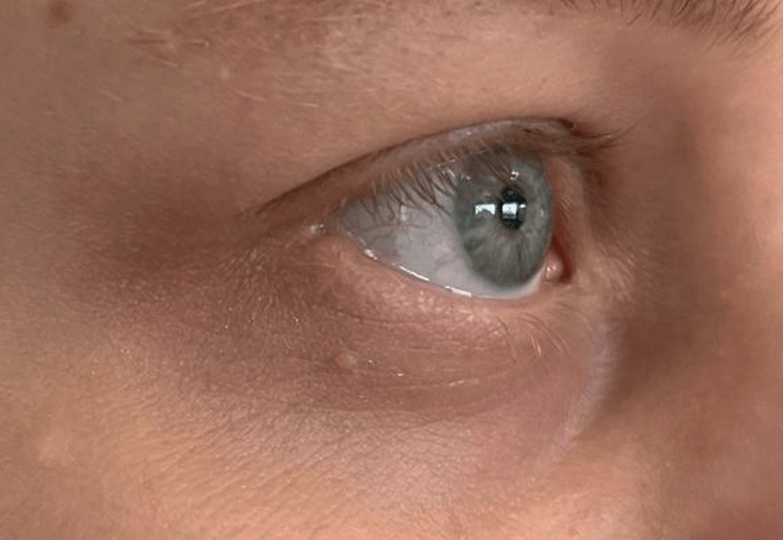 After using on dark circles